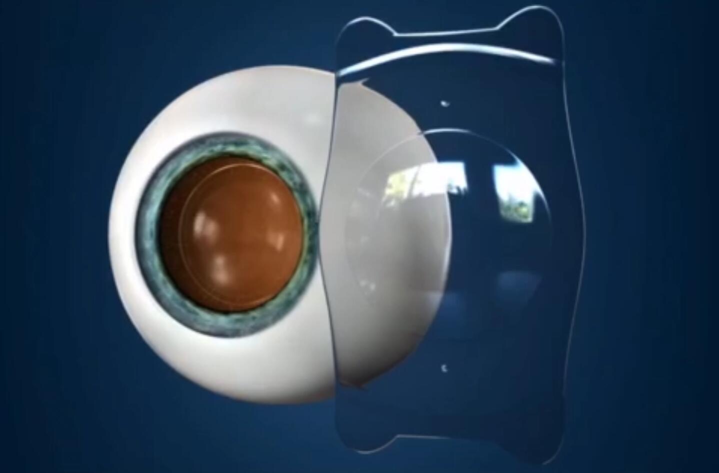 icl晶體植入術(shù)費用