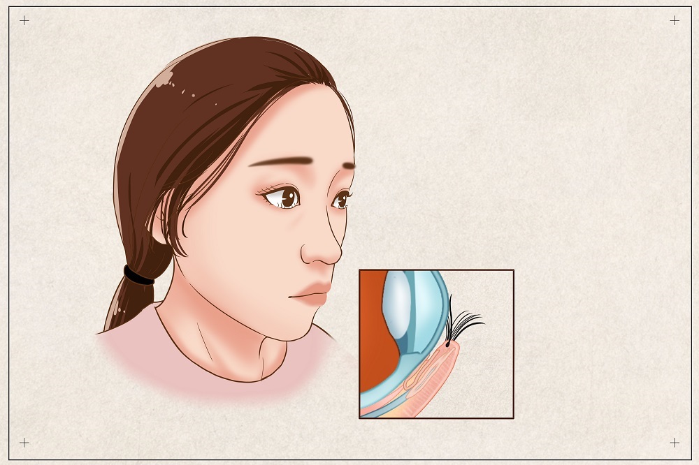 倒睫會(huì)自己好嗎？