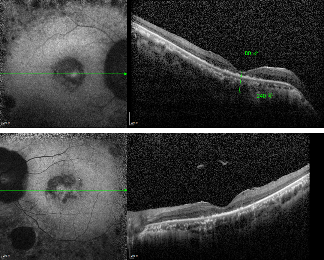 視網(wǎng)膜色素變性
